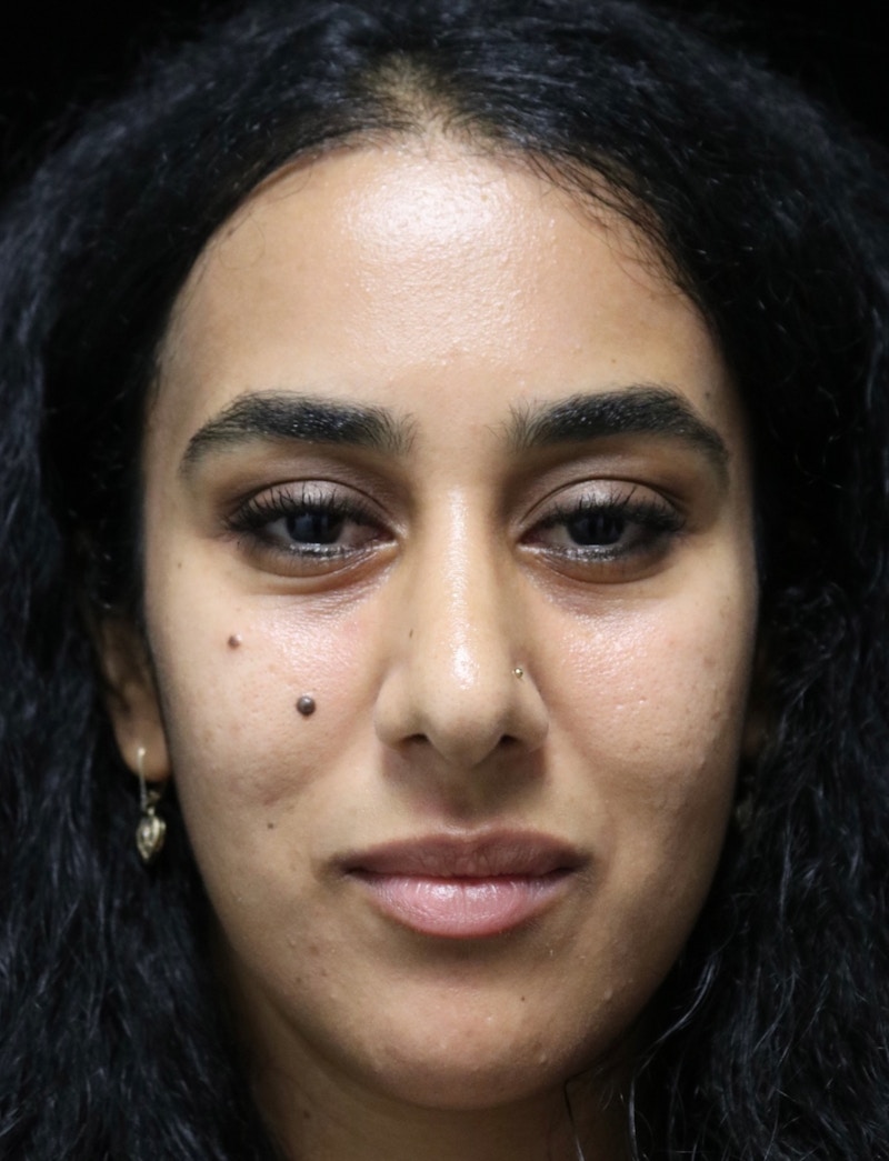 Beverly Hills Rhinoplasty Before & After Gallery - Patient 129926 - Image 6 Dr. Deepak Raj Dugar