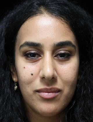 Beverly Hills Rhinoplasty Before & After Gallery - Patient 129926 - Image 6 Dr. Deepak Raj Dugar