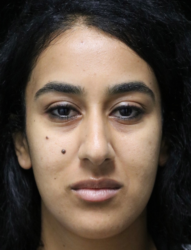 Beverly Hills Rhinoplasty Before & After Gallery - Patient 129926 - Image 5 Dr. Deepak Raj Dugar