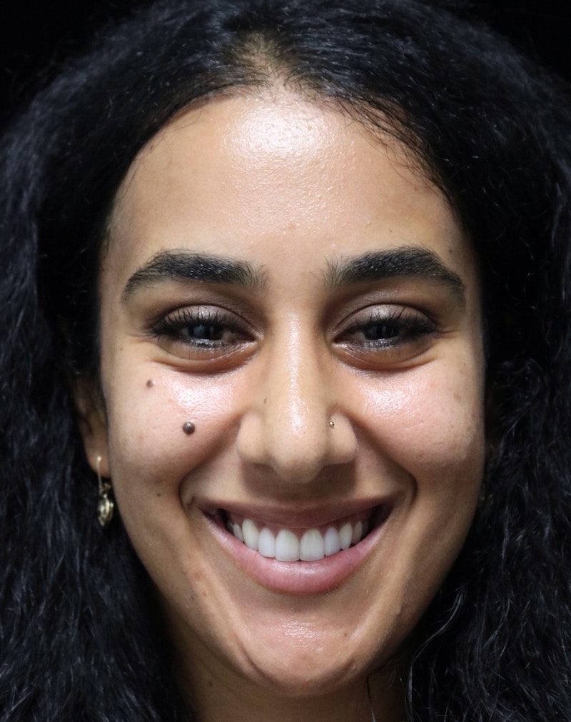 Beverly Hills Rhinoplasty Before & After Gallery - Patient 129926 - Image 8 Dr. Deepak Raj Dugar