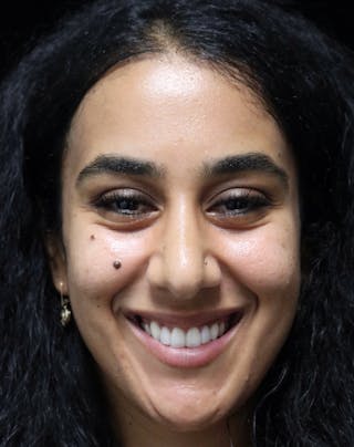 Beverly Hills Rhinoplasty Before & After Gallery - Patient 129926 - Image 8 Dr. Deepak Raj Dugar