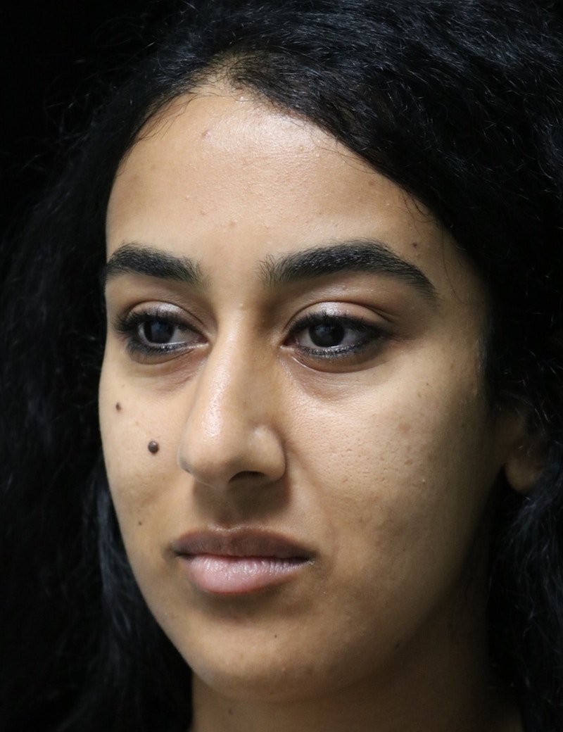 Beverly Hills Rhinoplasty Before & After Gallery - Patient 129926 - Image 9 Dr. Deepak Raj Dugar