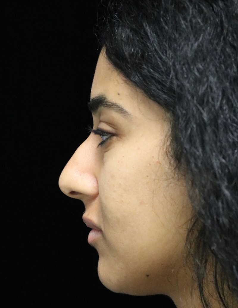 Beverly Hills Rhinoplasty Before & After Gallery - Patient 129926 - Image 11 Dr. Deepak Raj Dugar