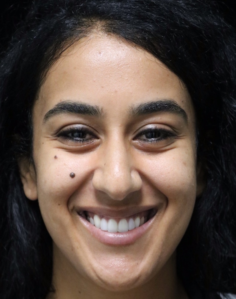 Beverly Hills Rhinoplasty Before & After Gallery - Patient 129926 - Image 7 Dr. Deepak Raj Dugar