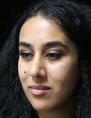 Beverly Hills Rhinoplasty Before & After Gallery - Patient 129926 - Image 10 Dr. Deepak Raj Dugar