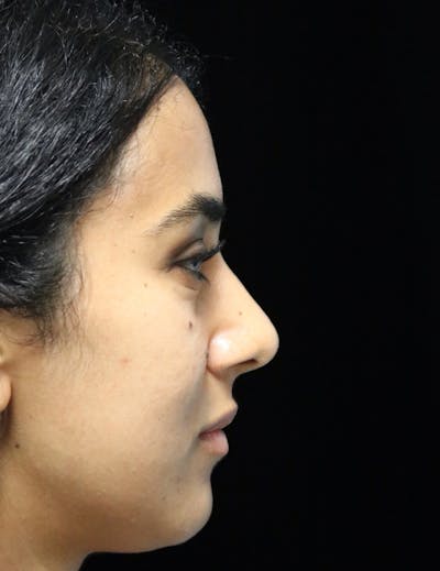 Beverly Hills Rhinoplasty Before & After Gallery - Patient 129926 - Image 2 Dr. Deepak Raj Dugar