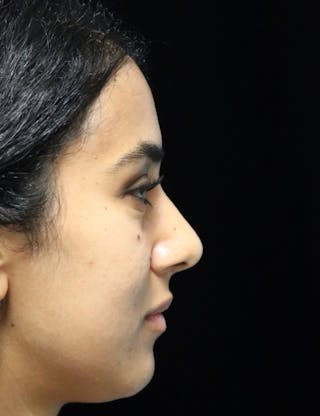 Beverly Hills Rhinoplasty Before & After Gallery - Patient 129926 - Image 2 Dr. Deepak Raj Dugar