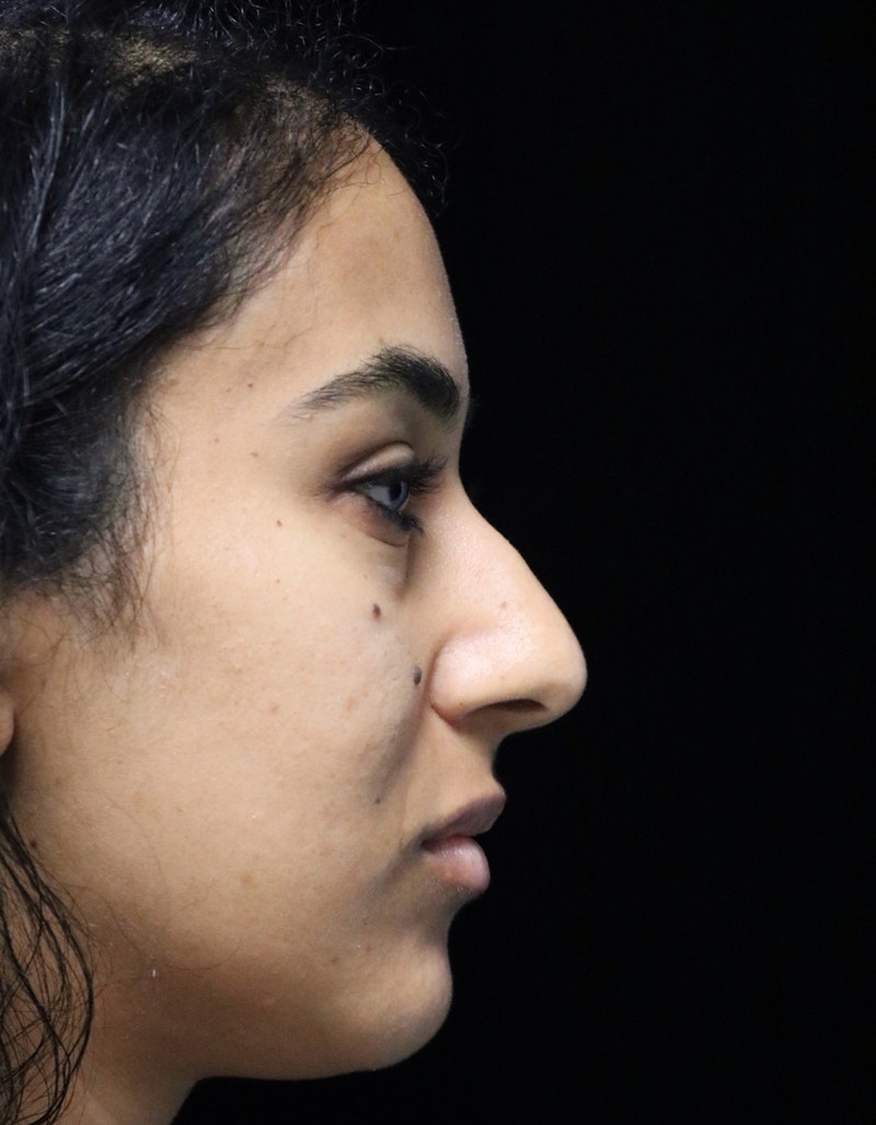 Beverly Hills Rhinoplasty Before & After Gallery - Patient 129926 - Image 1 Dr. Deepak Raj Dugar