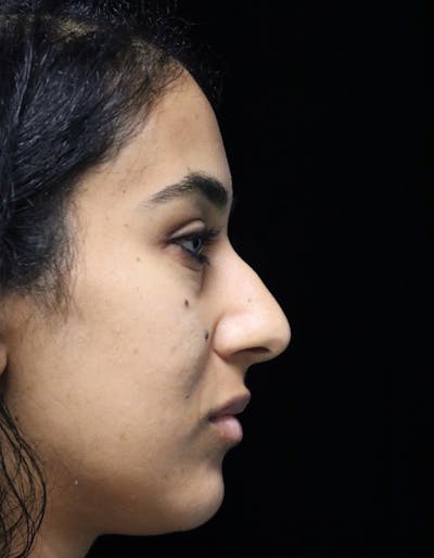 Beverly Hills Rhinoplasty Before & After Gallery - Patient 129926 - Image 1 Dr. Deepak Raj Dugar