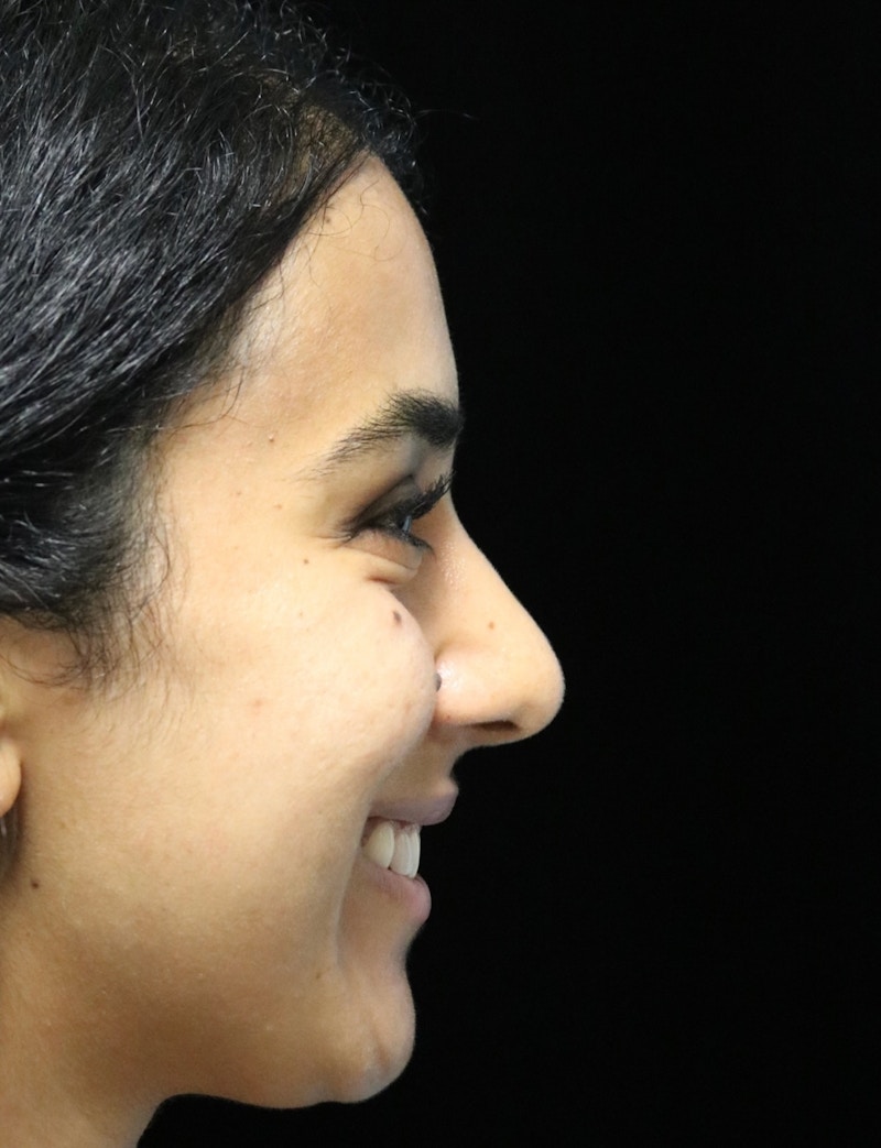 Beverly Hills Rhinoplasty Before & After Gallery - Patient 129926 - Image 4 Dr. Deepak Raj Dugar