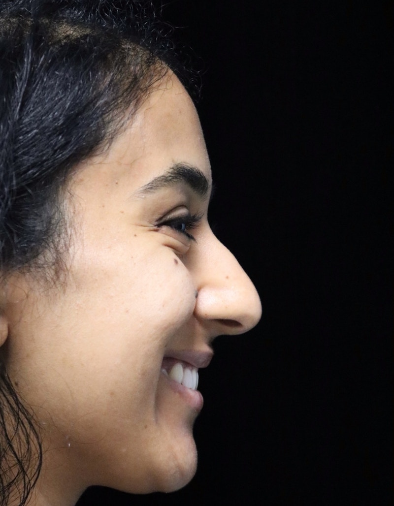 Beverly Hills Rhinoplasty Before & After Gallery - Patient 129926 - Image 3 Dr. Deepak Raj Dugar