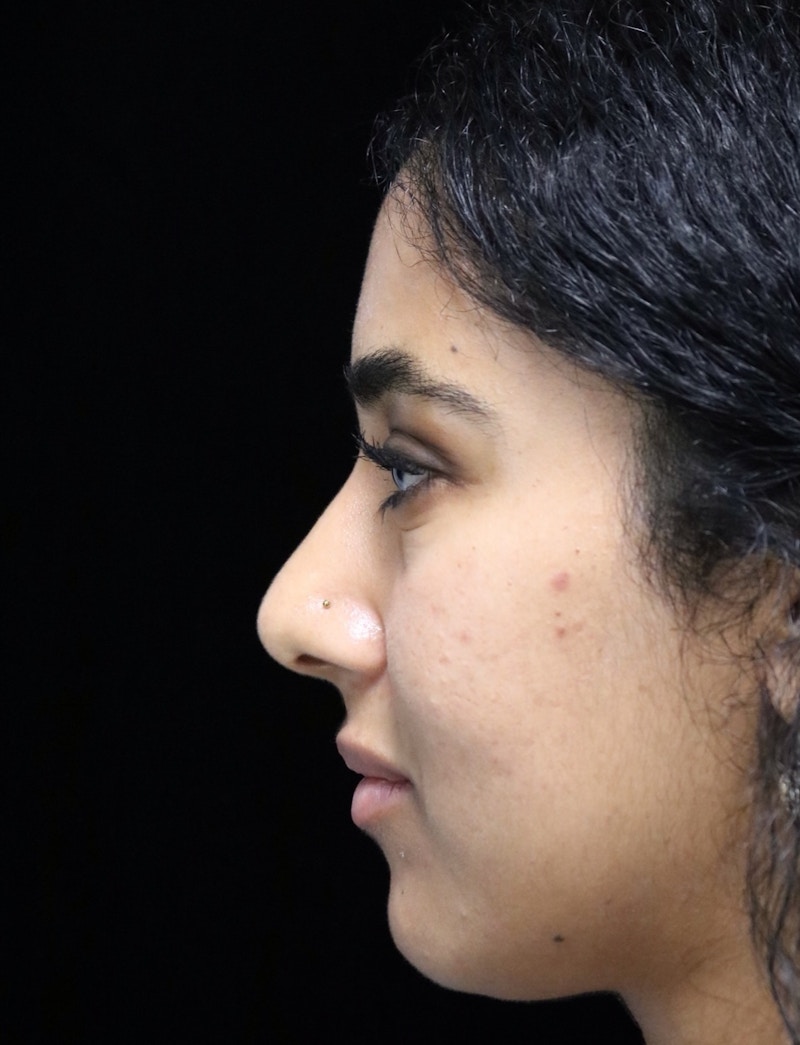 Beverly Hills Rhinoplasty Before & After Gallery - Patient 129926 - Image 12 Dr. Deepak Raj Dugar