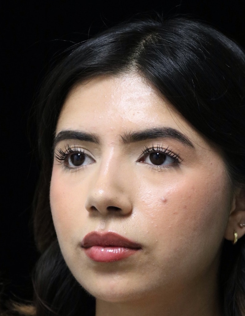 Beverly Hills Rhinoplasty Before & After Gallery - Patient 670635 - Image 6 Dr. Deepak Raj Dugar