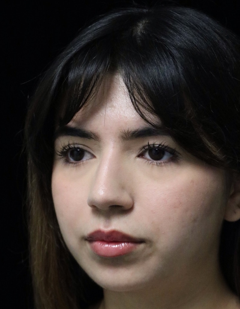 Beverly Hills Rhinoplasty Before & After Gallery - Patient 670635 - Image 5 Dr. Deepak Raj Dugar