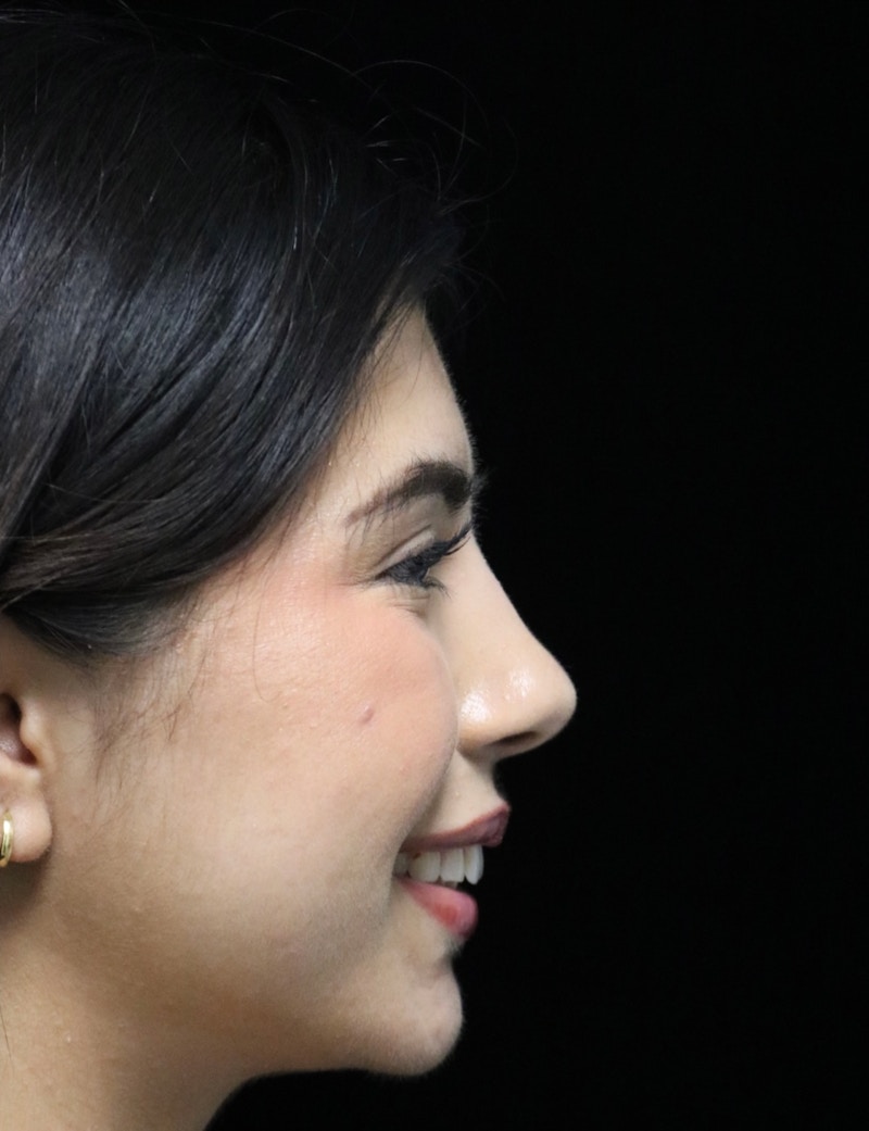 Beverly Hills Rhinoplasty Before & After Gallery - Patient 670635 - Image 4 Dr. Deepak Raj Dugar