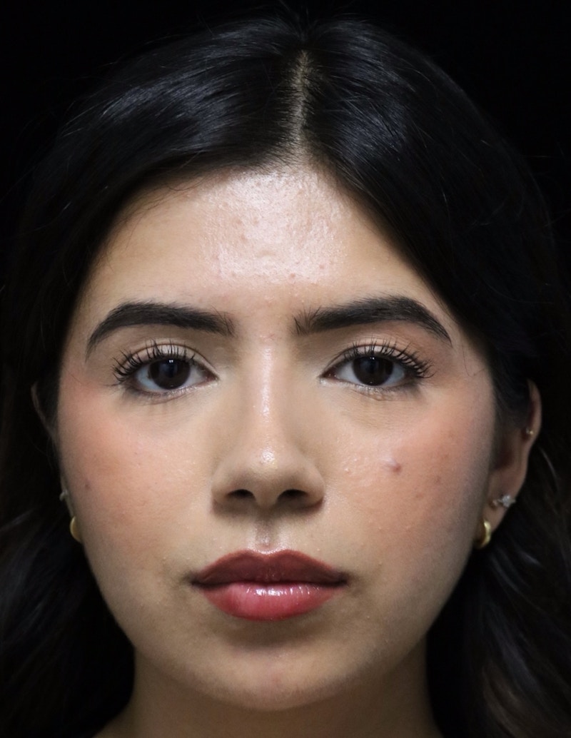 Beverly Hills Rhinoplasty Before & After Gallery - Patient 670635 - Image 10 Dr. Deepak Raj Dugar