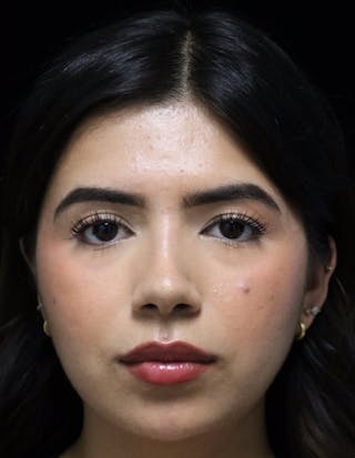 Beverly Hills Rhinoplasty Before & After Gallery - Patient 670635 - Image 10 Dr. Deepak Raj Dugar