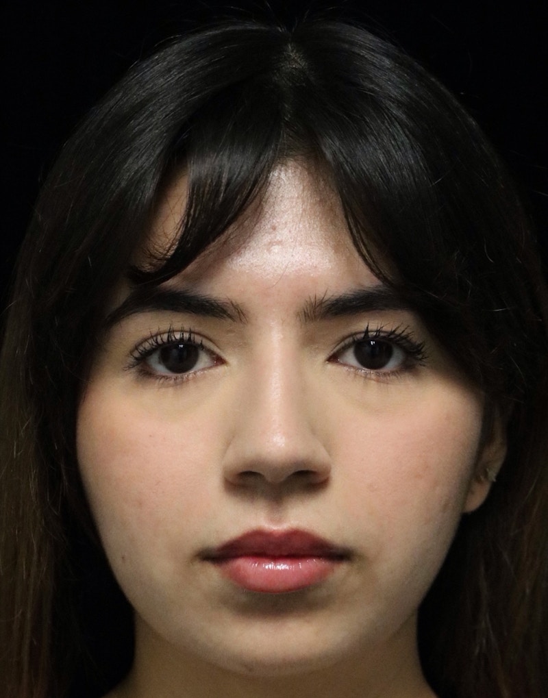 Beverly Hills Rhinoplasty Before & After Gallery - Patient 670635 - Image 9 Dr. Deepak Raj Dugar