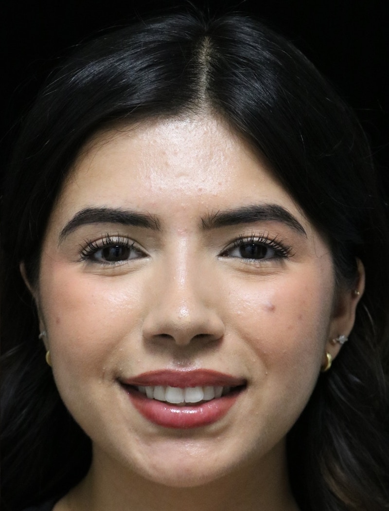 Beverly Hills Rhinoplasty Before & After Gallery - Patient 670635 - Image 8 Dr. Deepak Raj Dugar