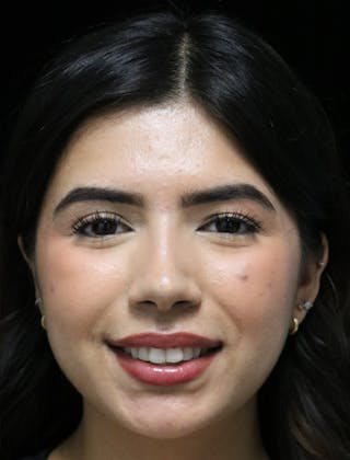 Beverly Hills Rhinoplasty Before & After Gallery - Patient 670635 - Image 8 Dr. Deepak Raj Dugar