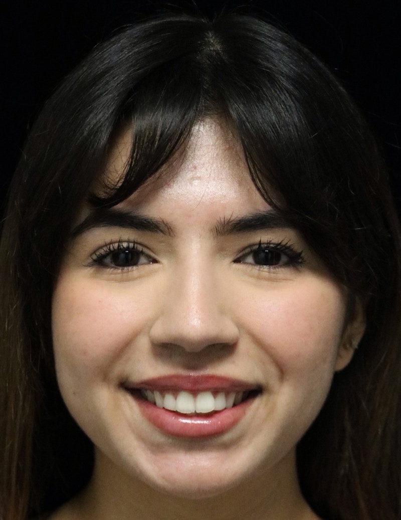 Beverly Hills Rhinoplasty Before & After Gallery - Patient 670635 - Image 7 Dr. Deepak Raj Dugar