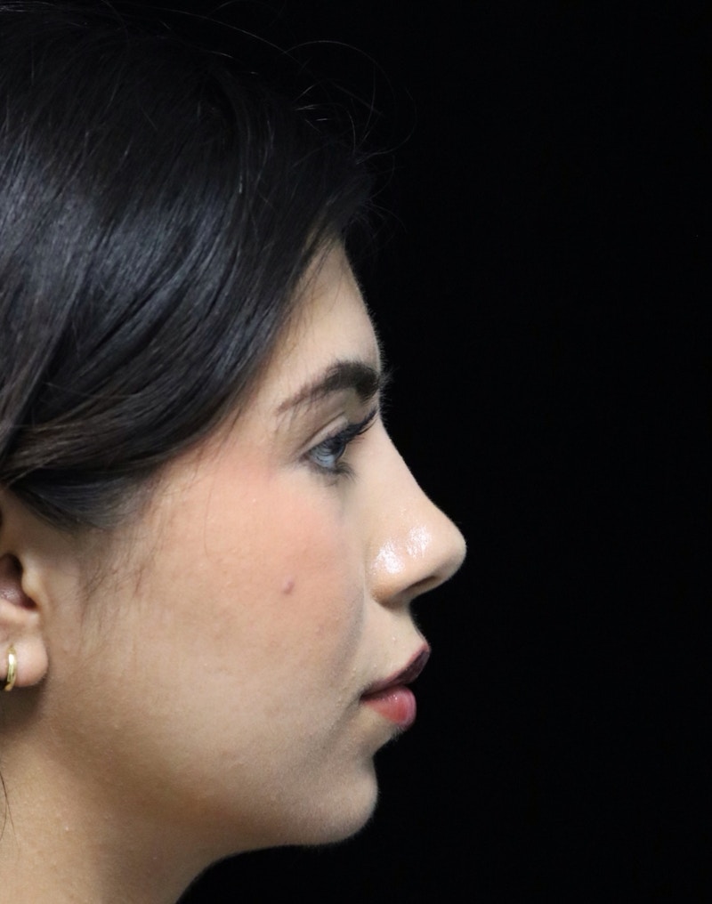 Beverly Hills Rhinoplasty Before & After Gallery - Patient 670635 - Image 2 Dr. Deepak Raj Dugar