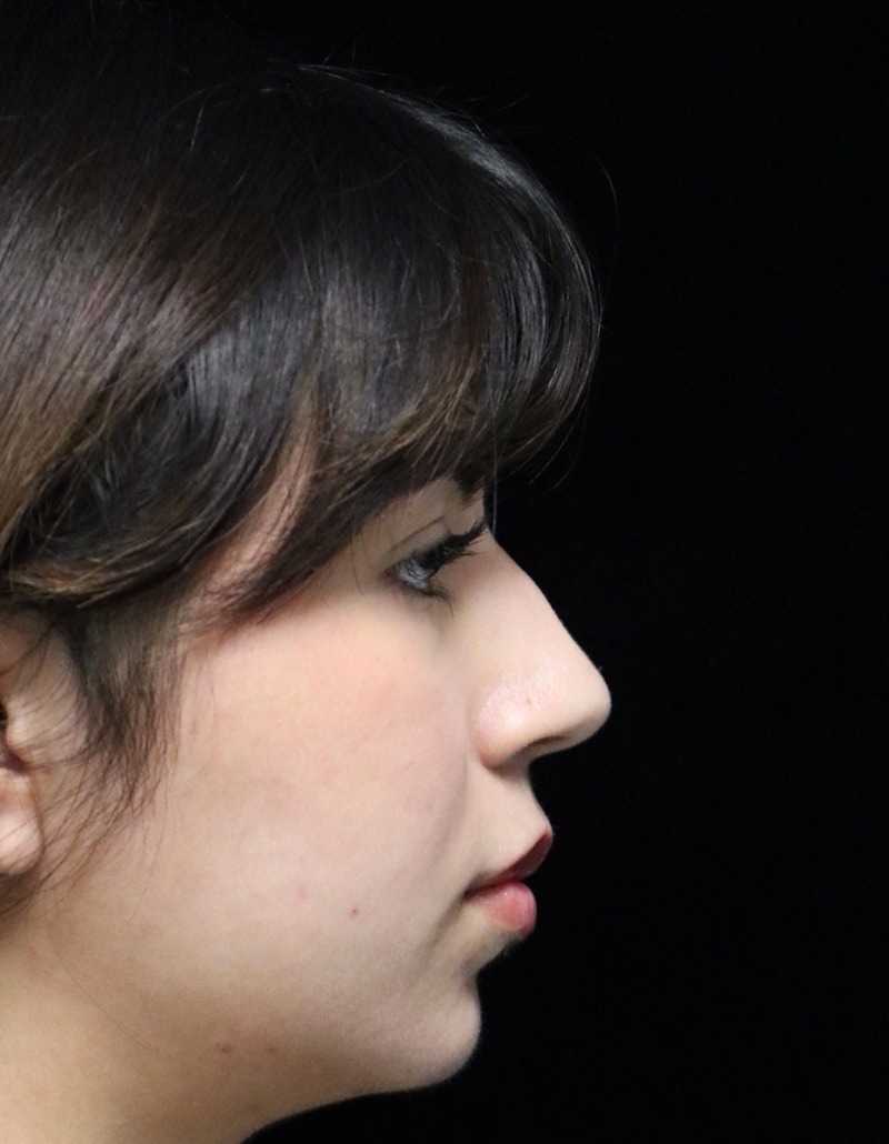 Beverly Hills Rhinoplasty Before & After Gallery - Patient 670635 - Image 1 Dr. Deepak Raj Dugar