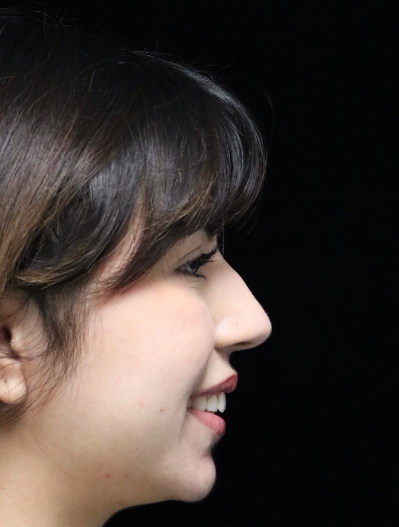 Beverly Hills Rhinoplasty Before & After Gallery - Patient 670635 - Image 3 Dr. Deepak Raj Dugar