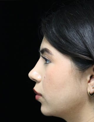 Beverly Hills Rhinoplasty Before & After Gallery - Patient 670635 - Image 12 Dr. Deepak Raj Dugar