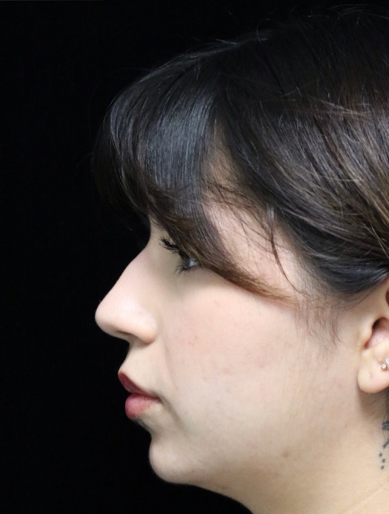 Beverly Hills Rhinoplasty Before & After Gallery - Patient 670635 - Image 11 Dr. Deepak Raj Dugar