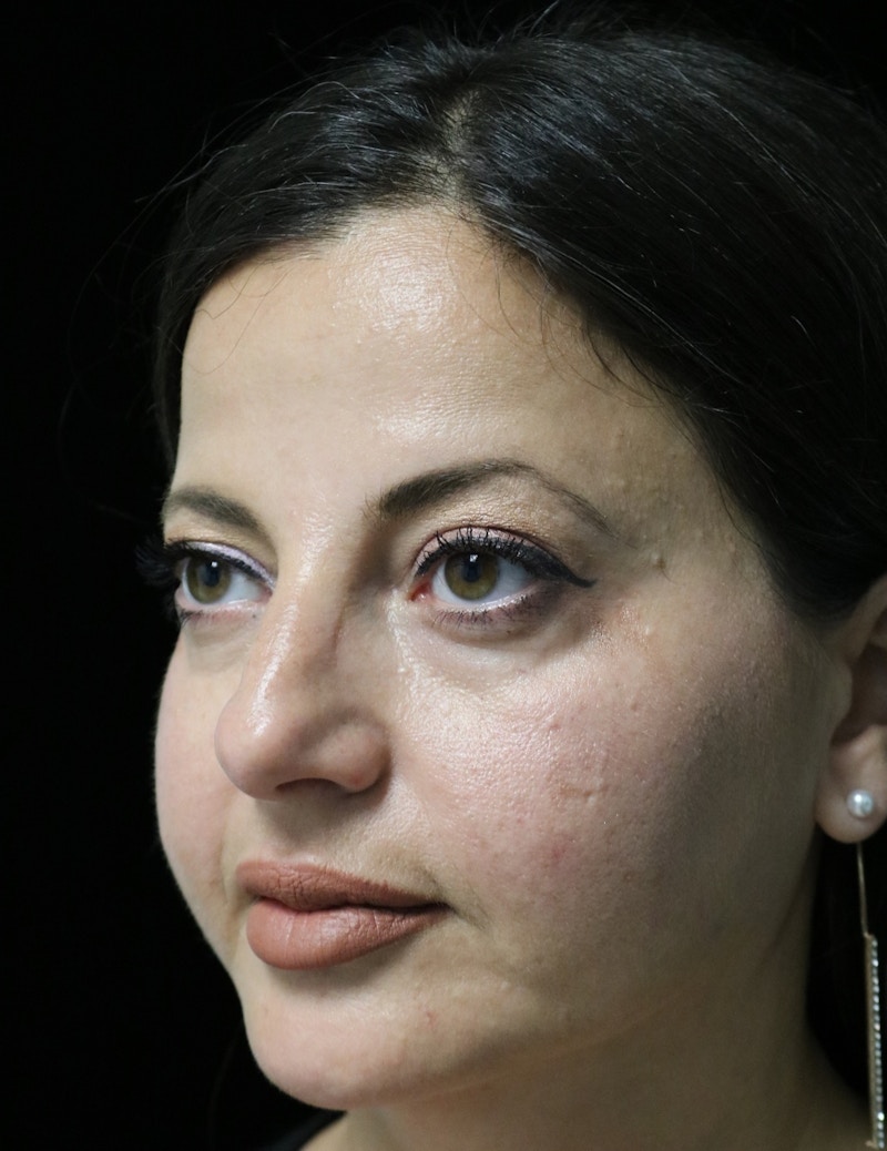 Beverly Hills Rhinoplasty Before & After Gallery - Patient 301516 - Image 7 Dr. Deepak Raj Dugar