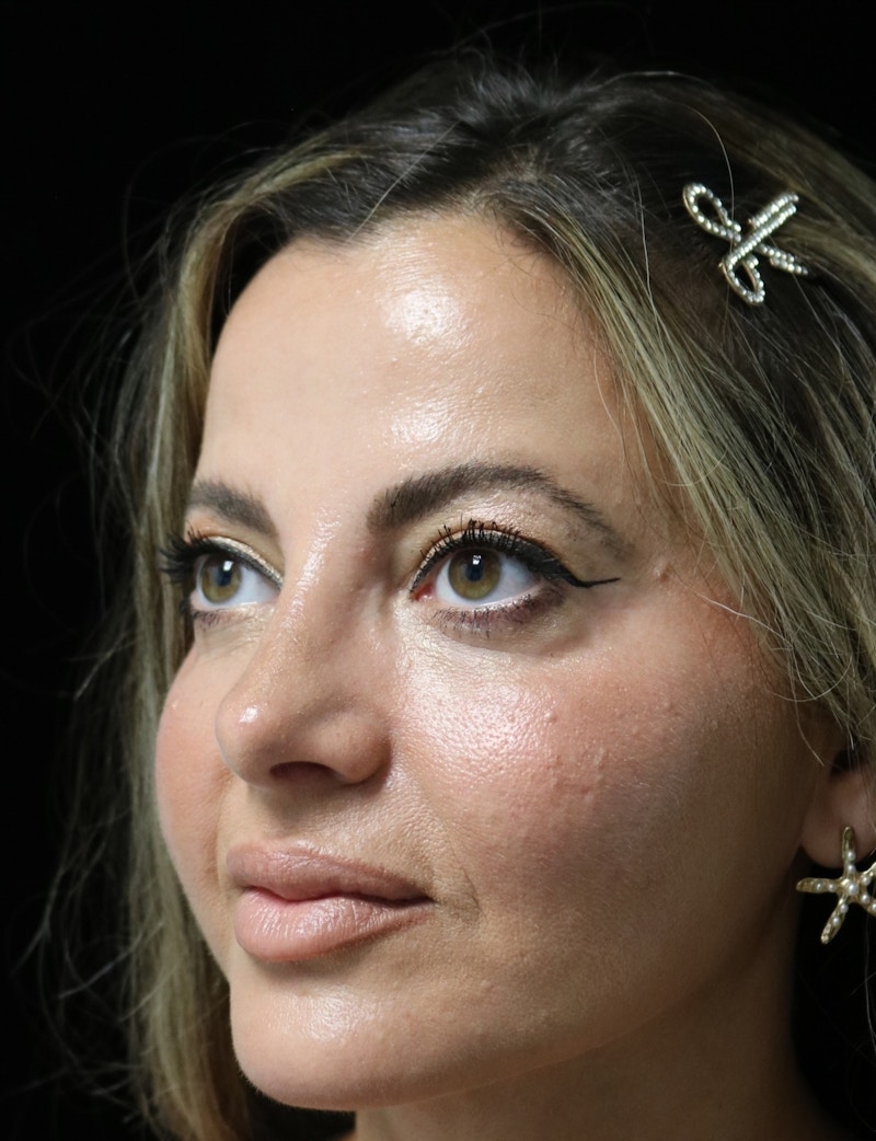 Beverly Hills Rhinoplasty Before & After Gallery - Patient 301516 - Image 8 Dr. Deepak Raj Dugar