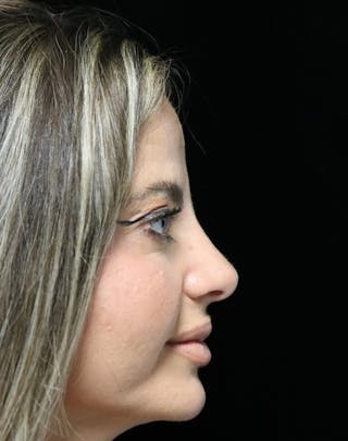 Beverly Hills Rhinoplasty Before & After Gallery - Patient 301516 - Image 2 Dr. Deepak Raj Dugar
