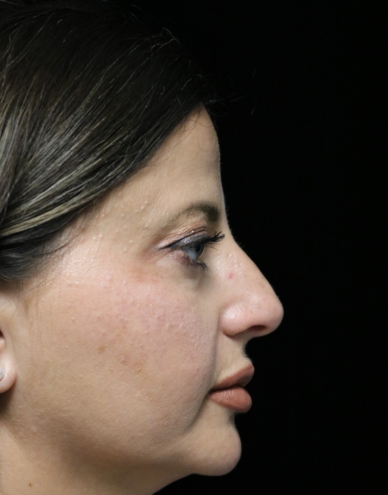 Beverly Hills Rhinoplasty Before & After Gallery - Patient 301516 - Image 1 Dr. Deepak Raj Dugar