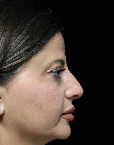Beverly Hills Rhinoplasty Before & After Gallery - Patient 301516 - Image 1 Dr. Deepak Raj Dugar