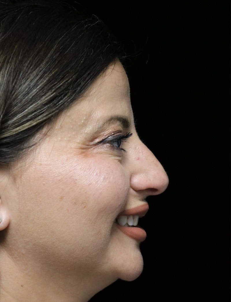 Beverly Hills Rhinoplasty Before & After Gallery - Patient 301516 - Image 3 Dr. Deepak Raj Dugar