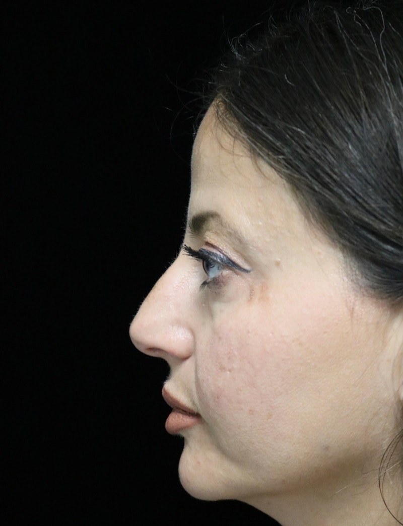 Beverly Hills Rhinoplasty Before & After Gallery - Patient 301516 - Image 9 Dr. Deepak Raj Dugar