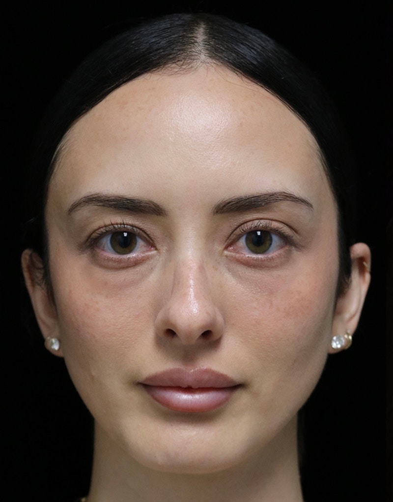 Beverly Hills Rhinoplasty Before & After Gallery - Patient 122052 - Image 9 Dr. Deepak Raj Dugar