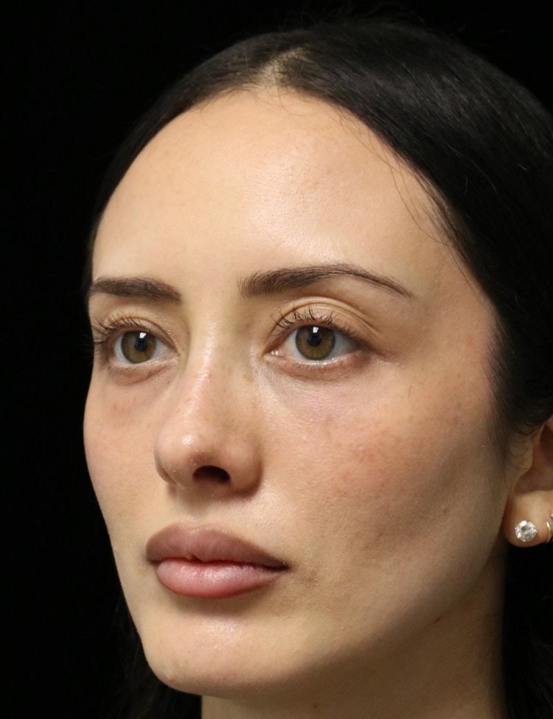 Beverly Hills Rhinoplasty Before & After Gallery - Patient 122052 - Image 8 Dr. Deepak Raj Dugar