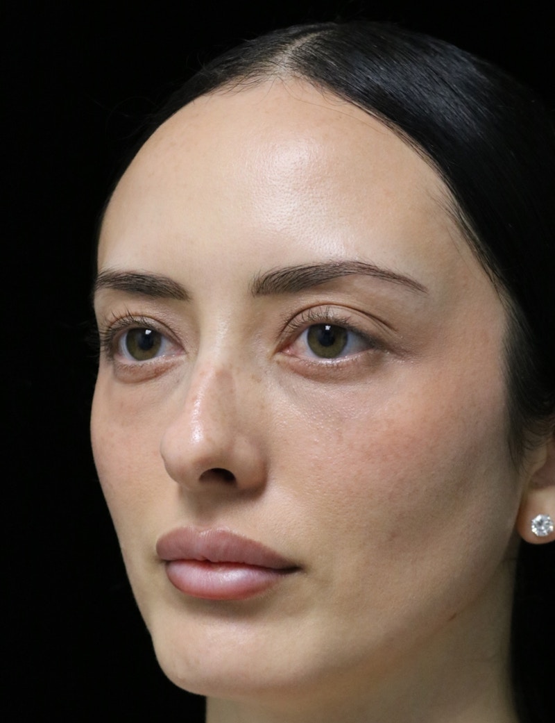 Beverly Hills Rhinoplasty Before & After Gallery - Patient 122052 - Image 7 Dr. Deepak Raj Dugar