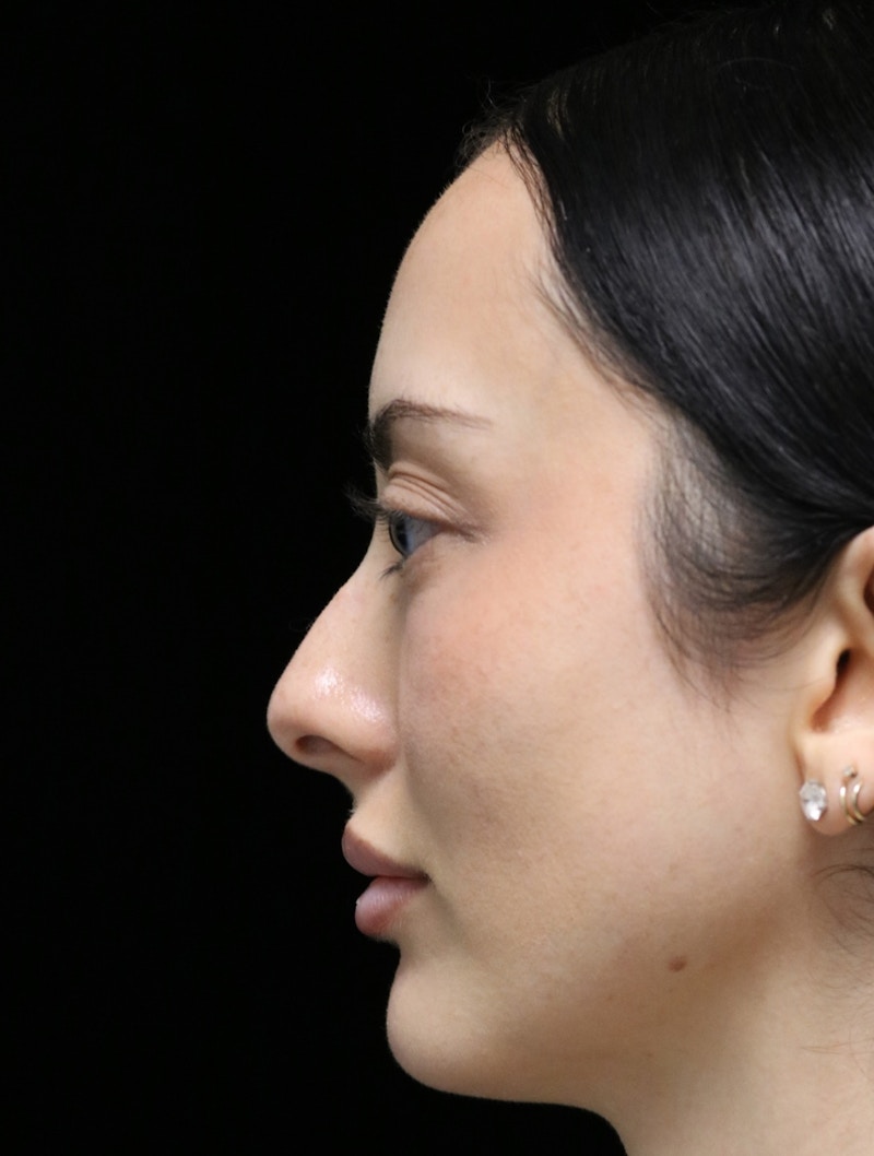 Beverly Hills Rhinoplasty Before & After Gallery - Patient 122052 - Image 5 Dr. Deepak Raj Dugar