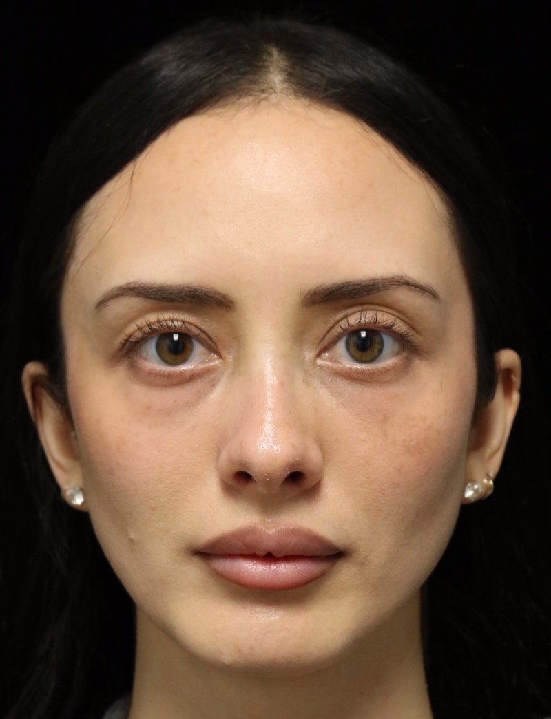 Beverly Hills Rhinoplasty Before & After Gallery - Patient 122052 - Image 10 Dr. Deepak Raj Dugar