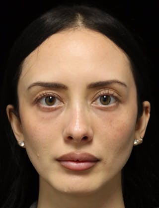 Beverly Hills Rhinoplasty Before & After Gallery - Patient 122052 - Image 10 Dr. Deepak Raj Dugar