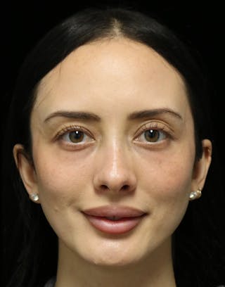 Beverly Hills Rhinoplasty Before & After Gallery - Patient 122052 - Image 12 Dr. Deepak Raj Dugar