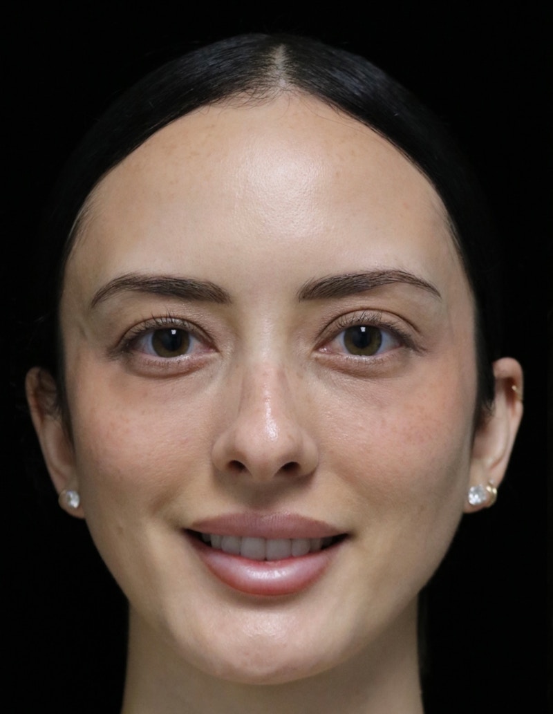 Beverly Hills Rhinoplasty Before & After Gallery - Patient 122052 - Image 11 Dr. Deepak Raj Dugar