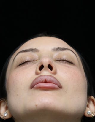 Beverly Hills Rhinoplasty Before & After Gallery - Patient 122052 - Image 14 Dr. Deepak Raj Dugar