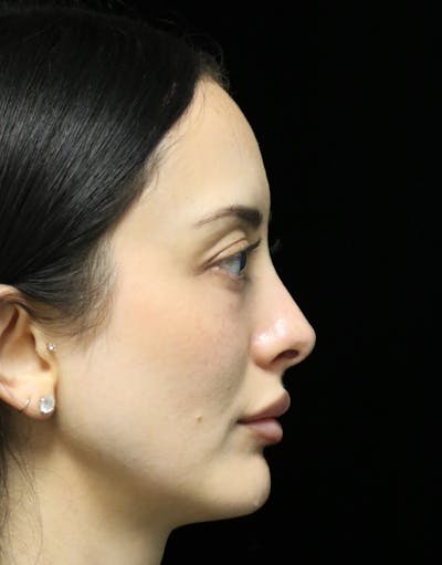 Beverly Hills Rhinoplasty Before & After Gallery - Patient 122052 - Image 2 Dr. Deepak Raj Dugar
