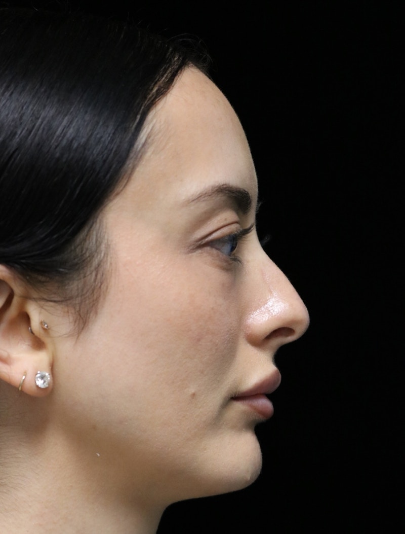 Beverly Hills Rhinoplasty Before & After Gallery - Patient 122052 - Image 1 Dr. Deepak Raj Dugar