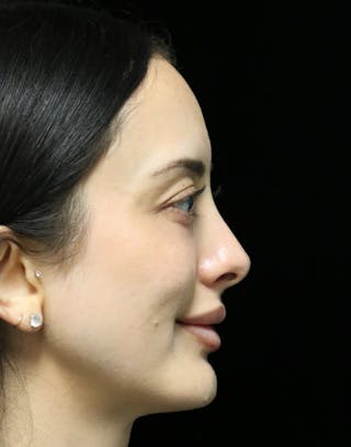 Beverly Hills Rhinoplasty Before & After Gallery - Patient 122052 - Image 4 Dr. Deepak Raj Dugar