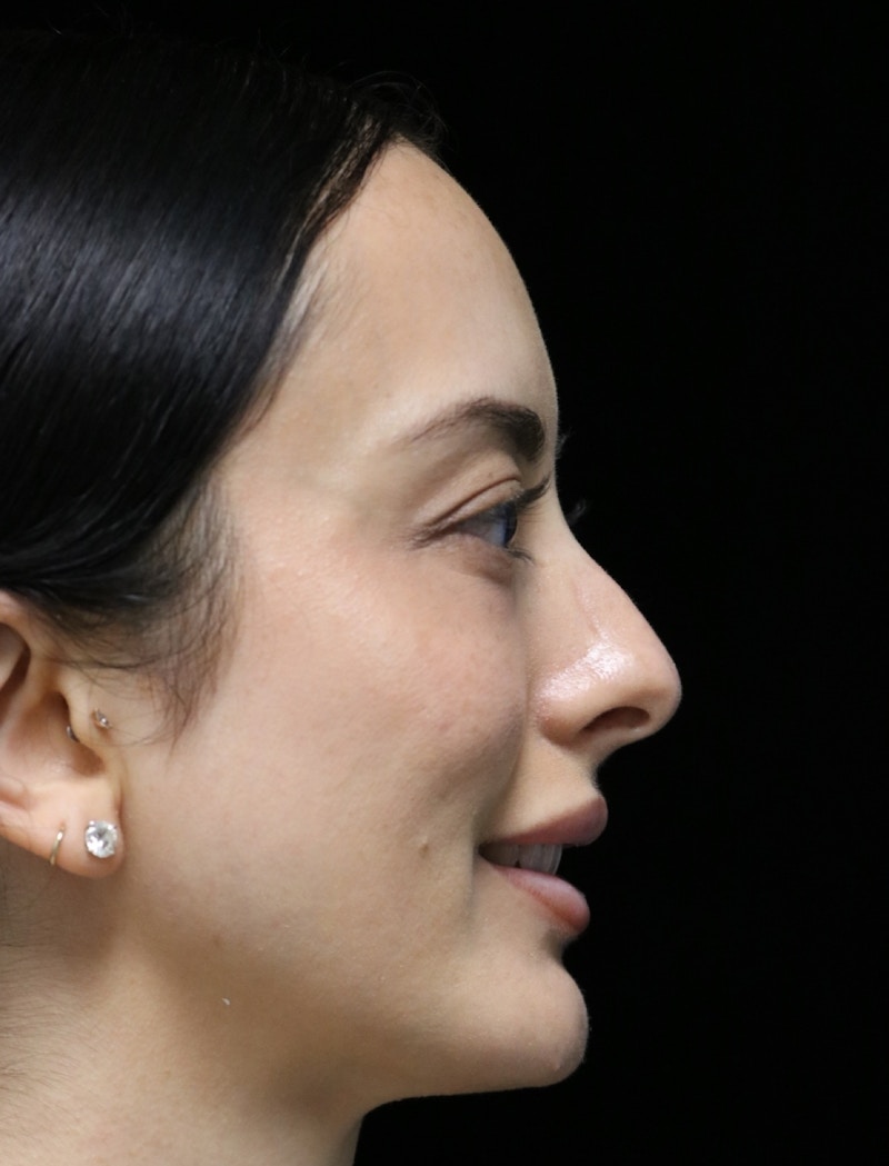 Beverly Hills Rhinoplasty Before & After Gallery - Patient 122052 - Image 3 Dr. Deepak Raj Dugar